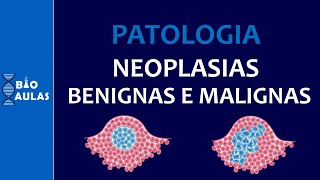 Neoplasias Benignas e Malignas  Características Nomenclatura e Diferenciação Patologia Geral [upl. by Daniels]