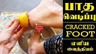 பாத வெடிப்பு நீங்க நல்ல வைத்தியம்  Foot Crack Remedies in Tamil [upl. by Gnihc]