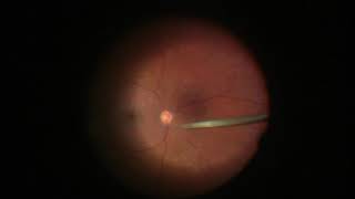 Endolaser Panretinal Photocoagulation PRP [upl. by Nibot]