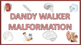 Dandy Walker Syndrome  Causes Signs amp Symptoms Pathophysiology Diagnosis [upl. by Gretal]