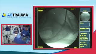 Percutaneous insertion of S1 iliosacral screw Mr Anthony Ward [upl. by Htebyram658]