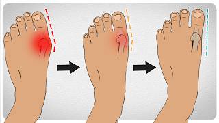 How to Fix Bunions in 5 Steps [upl. by Lawford]