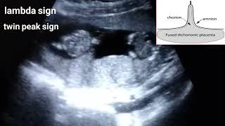 Dichorionic diamniotic twin pregnancylambda sign [upl. by Suhsoj724]