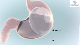 Elipse Intragastric Balloon Animation Video [upl. by Zilef706]