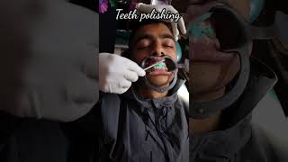 10 months braces result  Disturbed bite before after teeth cleaning polishing  Orthodontist [upl. by Par]