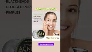 Wellution Cystic Acne Treatment face Cream howtolightendarkspots antiaging [upl. by Gamaliel833]