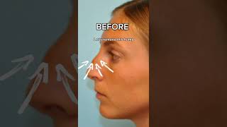 RHINOPLASTY RESULTS  DR TANVEER JANJUA  NEW JERSEY [upl. by Roede]