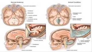 Dandy Walker Syndrome [upl. by Freudberg]