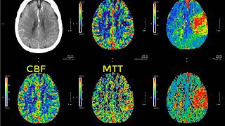 Introduction to CT perfusion before Call [upl. by Ruthanne]