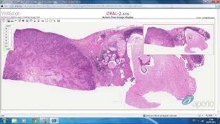 Mucoepidermoid Carcinoma Salivary gland tumor 🔬salivarygland cancer tumors [upl. by Olegnalehcim]