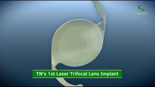 1st Laser Trifocal Lens Implant in Tennessee [upl. by Asilim563]