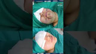 Increíble resultado de una LIPOPAPADA  BICHECTOMÍA Antes y después  Lipoylaser Perú [upl. by Lolita701]