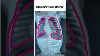 Bilateral Pneumothorax [upl. by Harutek]