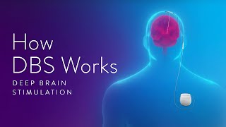 How Deep Brain Stimulation DBS Works [upl. by Aerdnaeel]