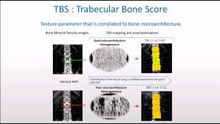 How to use TBS Trabecular Bone Score in combination with BMD in Clinical DXA practice [upl. by Chad]