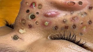 Loan Nguyen Acne Treatment 31d [upl. by Jyoti]