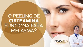 O Peeling de Cisteamina funciona para Melasma [upl. by Marjy]