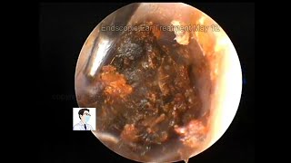 Review of hard cerumen embolism May 13 2022 [upl. by Ardnas]