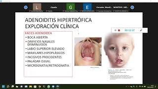 ⭕​ADENOIDITIS  AMIGDALITIS  PATOLOGIA DEL ANILLO DE WALDEYER👅 [upl. by Tiena]