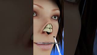 Transform Your Nose with Rhinoplasty shorts  Creativelearning3d [upl. by Tare]