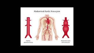 Aortic Aneurysm Symptoms and Causes  Diagnosis  Treatment  Prevention healthcare [upl. by Atteloj381]