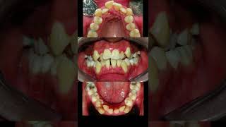 Braces for severe crowding teeth [upl. by Iramo]