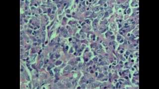 Diffuse large Bcell lymphoma [upl. by Mindi]