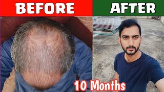 105 month result 2024 • Hair Transplant Complete Result 😯 Dr habib 2nd Transplant experience [upl. by Einaj43]