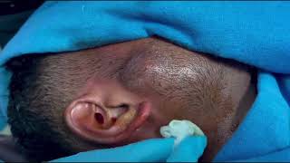 FACE ABSCESS  An immediate improvement after pus aspiration  Needle aspiration [upl. by Ahcurb]