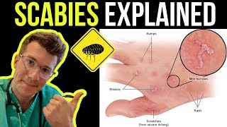 Doctor explains SCABIES skin rash including SYMPTOMS PHOTOS OF SKIN TREATMENT amp more [upl. by Acissaj167]