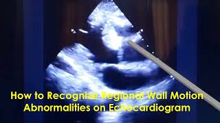 How to Recognize Regional Wall Motion Abnormalities on Echocardiogram [upl. by Wiedmann]