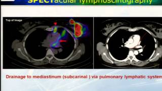 Lymphoscintigraphy with SPECTCT in Malignant Melanoma [upl. by Bobbi32]