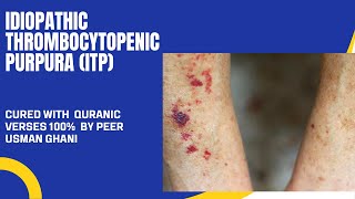 Idiopethic Thrombocytopenic Purpura ITP disease cured by Quranic verses [upl. by Nakasuji656]