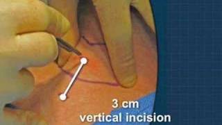 Cricothyrotomy [upl. by Giustino]