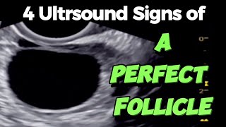 A Perfect Follicle  4 Ultrasound Signs  of Good Follicle for Easy Conceiving [upl. by Ociredef]