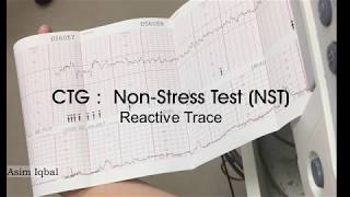 CTG Reactive Non Stress Test [upl. by Ainekahs]