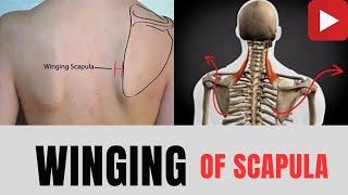 WINGING Of SCAPULACausesTreatmentwinging scapula causes treatment anatomy demage nerve yt [upl. by Kameko]