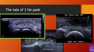 Forefoot ultrasound Pathology Lecture with live scan MTP web space [upl. by Cantlon]