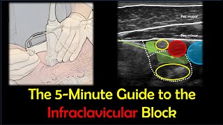 Infraclavicular Brachial Plexus Block  a quotHowToquot Guide [upl. by Rizan]