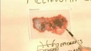 How to Identify Skin Cancer  Signs of Melanoma Carcinoma Skin Cancer [upl. by Eremehc]