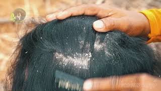 Extreme Dandruff Scratching Huge Flake And Dry Scalp Removal 63 [upl. by Hctub]