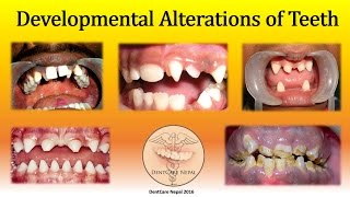 Developmental Defects of Teeth  Oral Pathology [upl. by Gillespie]