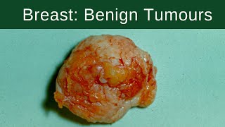 Breast Benign Tumours  Pathology mini tutorial [upl. by Atilamrac]