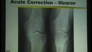 Lecture  High Tibial Osteotomy for Knee Arthritis  Part 3 [upl. by Alyworth880]