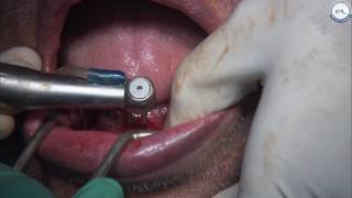 Full Arch Cemented Split Prosthesis for easy retrieval and maintainence [upl. by Ylurt476]