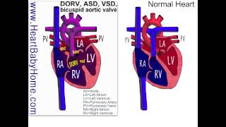 38 Double Outlet Right Ventricle with ASD VSD bicuspid aortic [upl. by Eilsehc]