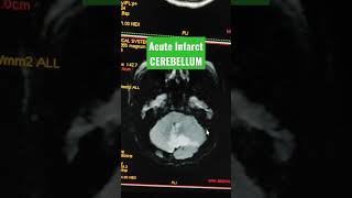 Large Acute Infarct in Cerebellum viral youtubeshorts mri [upl. by Erleena]