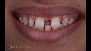 Combined approach for large diastema closure part II [upl. by Liebermann]