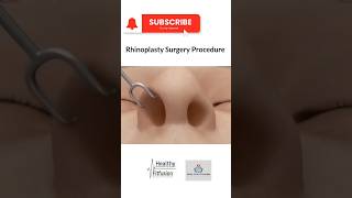 Rhinoplasty Surgery3D animationHealthyFitFusion195 shorts viralshorts medicaleducation facts [upl. by Eelana]