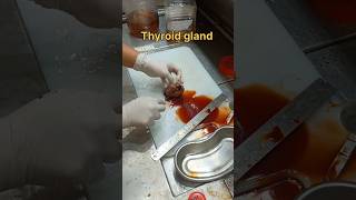 Cystic thyroid gland gross pathology [upl. by Kcinemod]